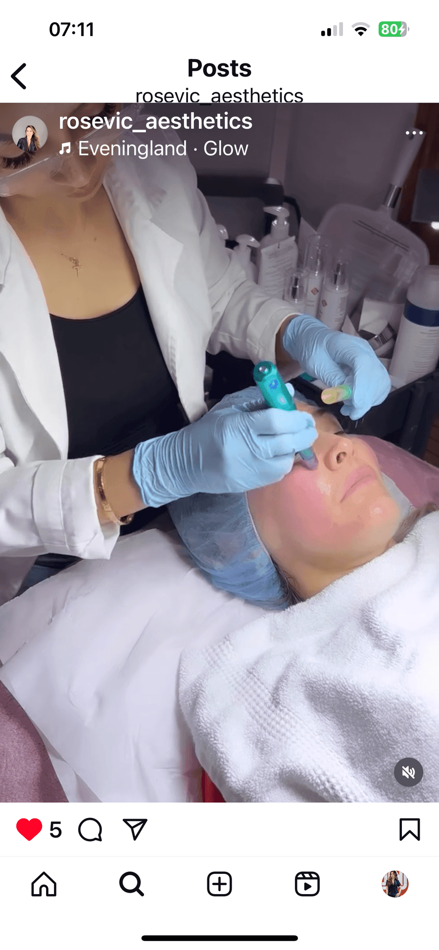 Microneedling 
