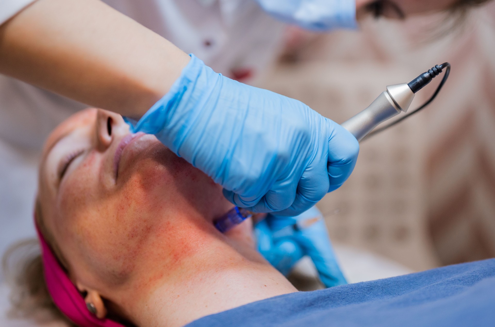 Dermapen micro-needling treatment for skin tightening lifting and rejuvenation