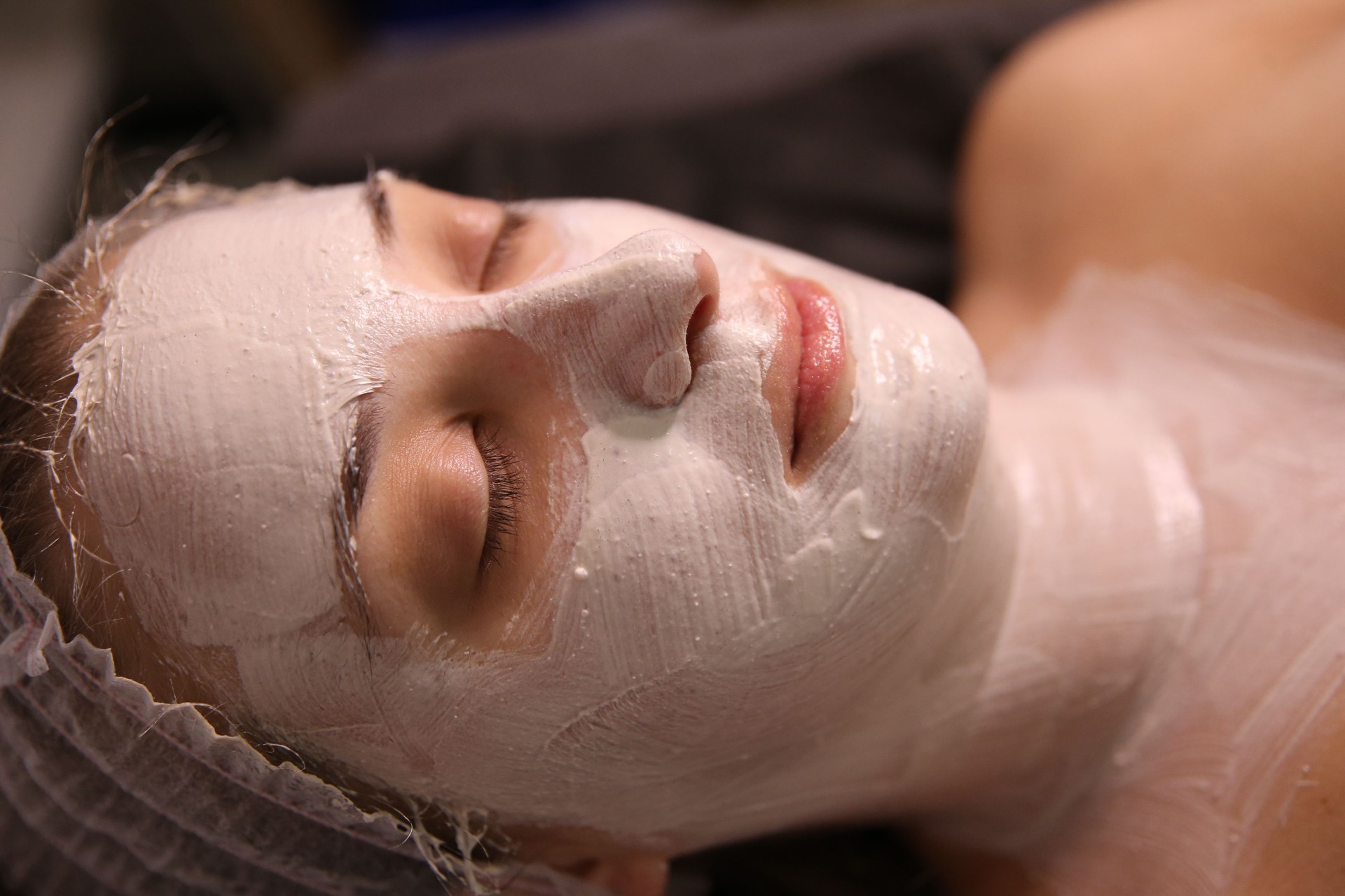 Chemical Peel
