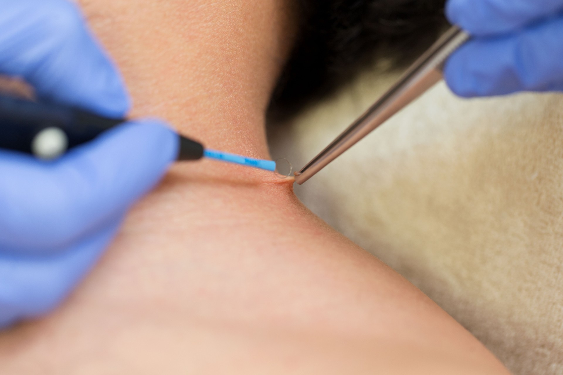 Warts removal